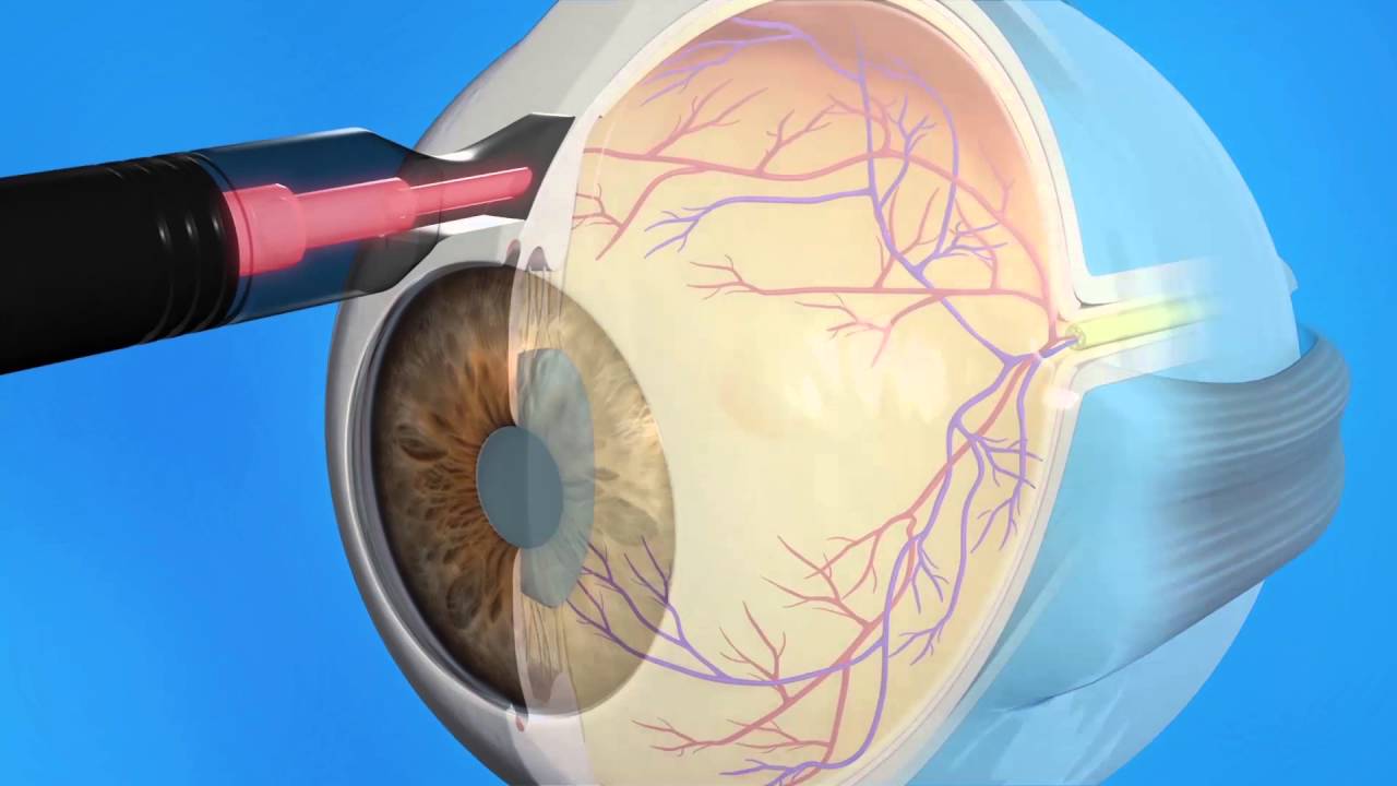 Glaucoma Cyclophotocoagulation CPC