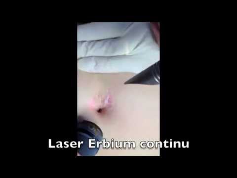 comment soigner nodule visage