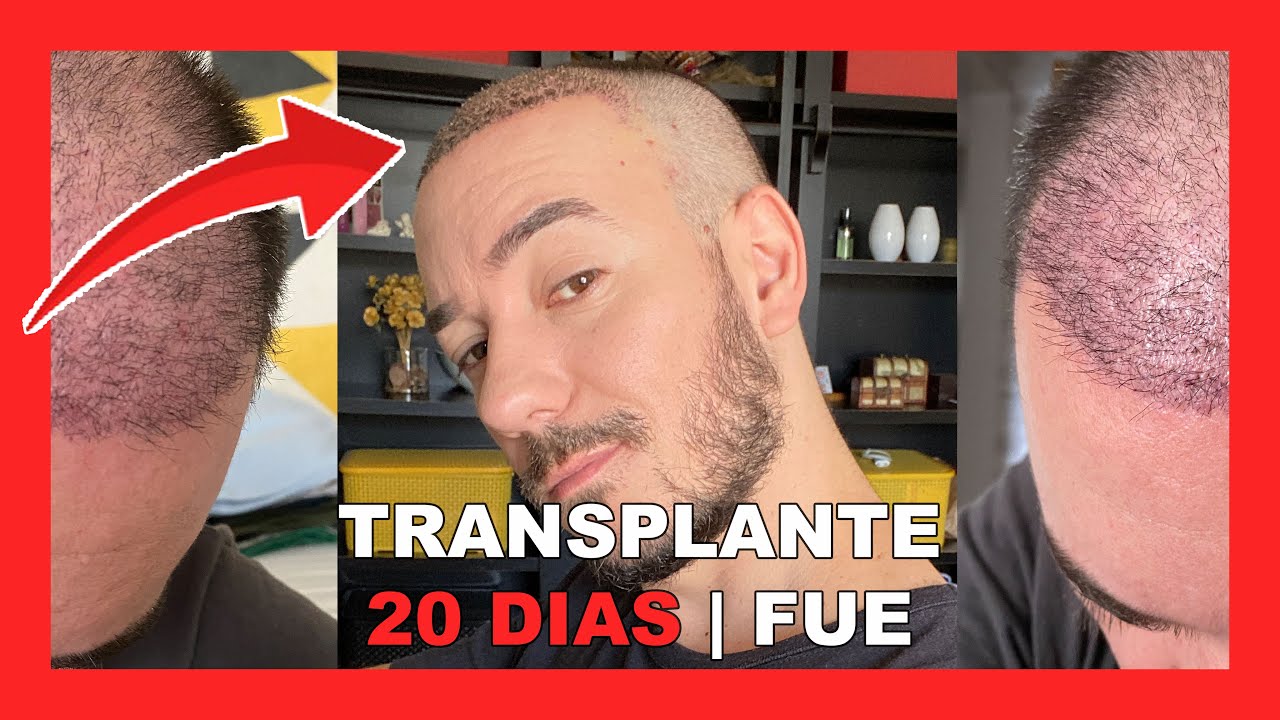 FIOS CAINDO APÓS TRANSPLANTE CAPILAR FUE