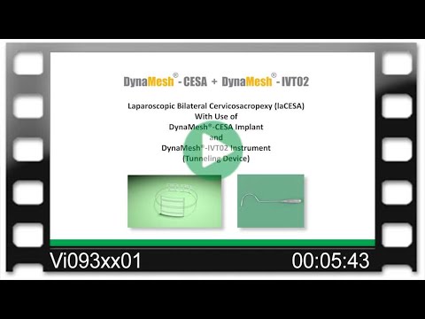 DynaMesh®-CESA /-IVT02 - OR-Video: LaCESA - Cervicosacropexy - Bilateral Fixation - Laparoscopy