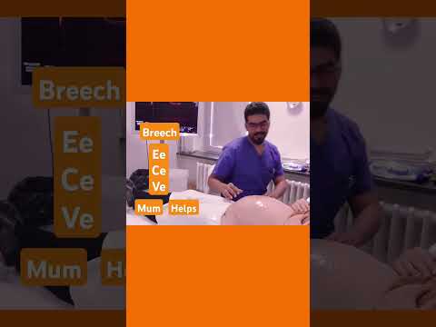 New style mummy bottoms up ECV 4 breech