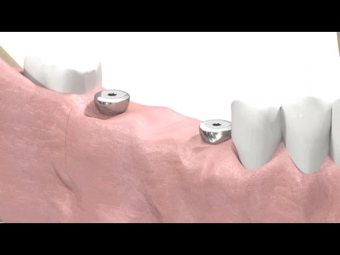 image-Are dental implants considered prosthetics?