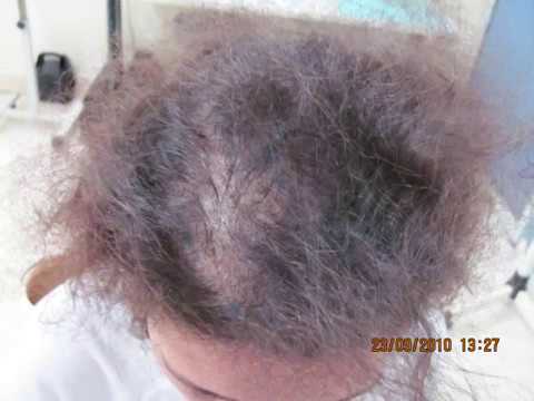 comment traiter la chute des cheveux chez la femme