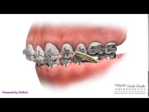 Elastics - Class II - Orthodontic Treatment