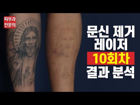 문신제거 레이저 10번 받으면 얼마나 지워질까?