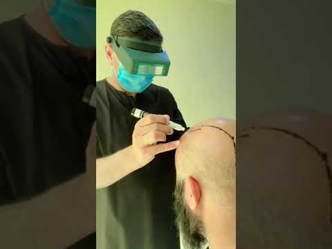 How Smart Hairlines Are Designed with Science | Dr. Rana Irfan