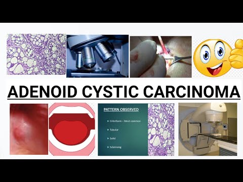 Prosztata adenoma műtét - 2. orvosi vélemény - Dr