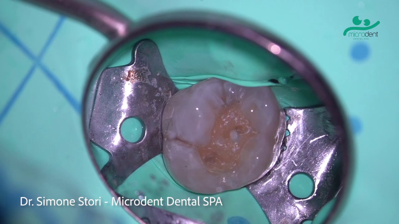 Watch Now Rimozione amalgama - Microdent Dental SPA - Dentista Bologna Rimozione amalgama - Microdent Dental SPA - Dentista Bologna