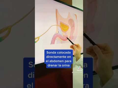 Estenosis uretral causa y tratamiento especializado