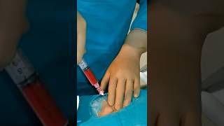 Download lagu Varicocele embolization live case - Step 1 | Dr. Gaurav Gangwani mp3