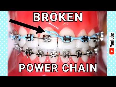 Broken Braces: What To Do If Your Power Chain Is Broken!