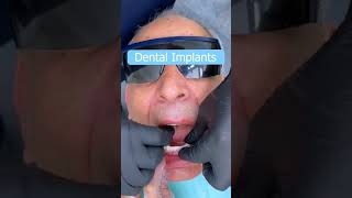 Dental Implants in Istanbul Turkey | Kristal Clinic