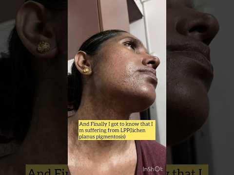 LPP can be cured with right medication and patience.Have faith in god and stay motivated 👍🏻