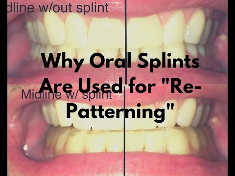 Why Oral Splints Are Sometimes Used During PRI Programs