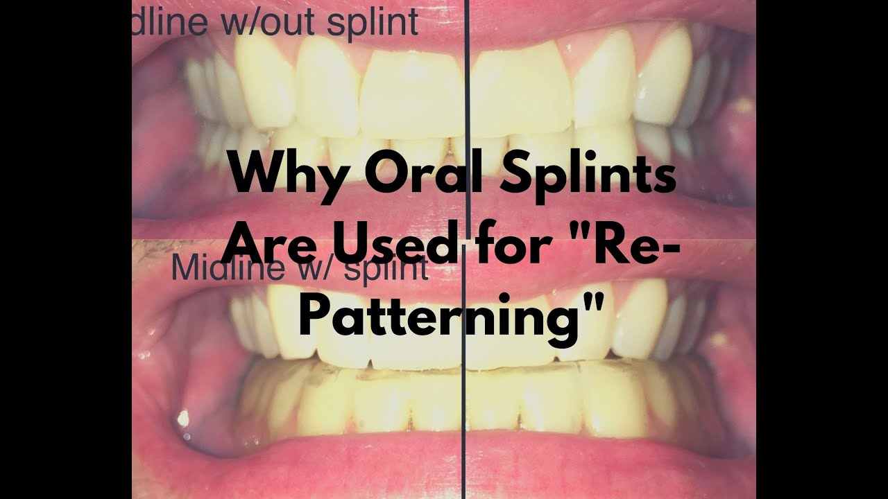 Why Oral Splints Are Sometimes Used During PRI Programs