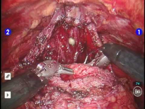 Anastomosis uretrovesical en dos planos durante una prostatectomía radical robótica