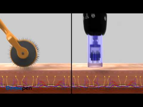 MicroNeedling Procedure Video by Dermapen®