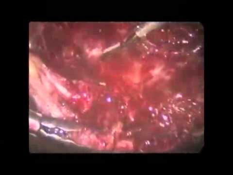 Laparoscopic Repair Of A Diaphragmatic Hernia At Site Of Previous Ventricular Assist Device