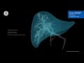 GE Healthcare Liver assist virtual parenchyma - A