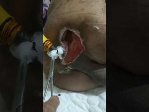 Hoại Tử Do Tiểu Đường, nằm lâu ngày