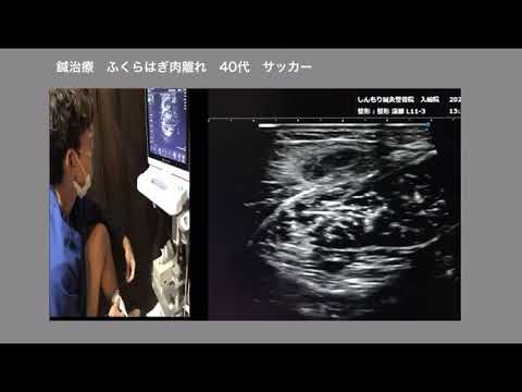 【人体実験】ふくらはぎ肉離れに鍼治療