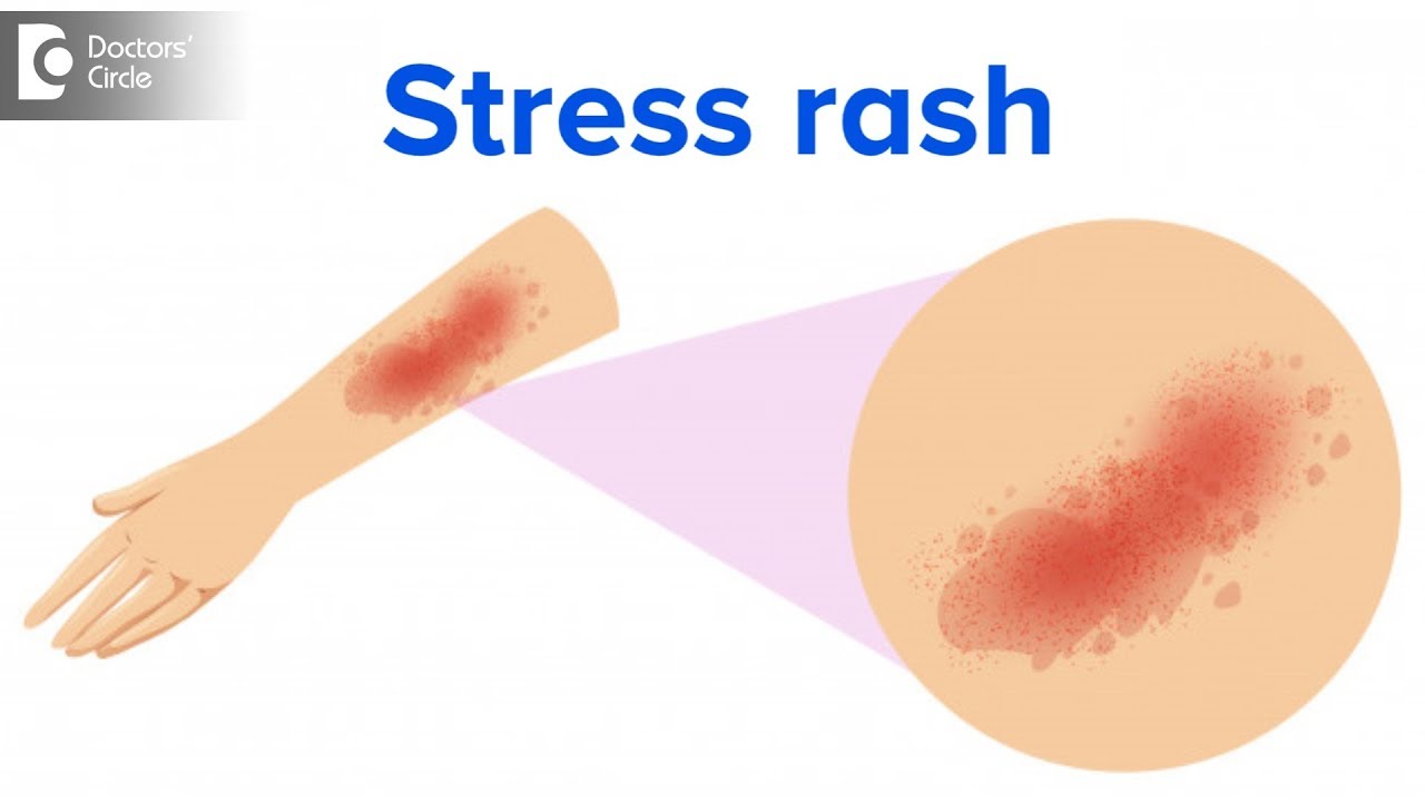 What does a stress rash look like on the neck? Tipseri