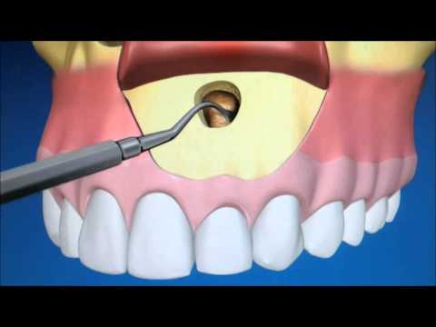 Apikotomija - Korijen zuba | Štimac Centar dentalne medicine | Apikotomija - kirurško odstranjenje vrška korijena | Stomatološka poliklinika Zagreb | Štimac centar dentalne medicine