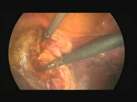 Pelvic Lymphadenectomy - Laparoscopy