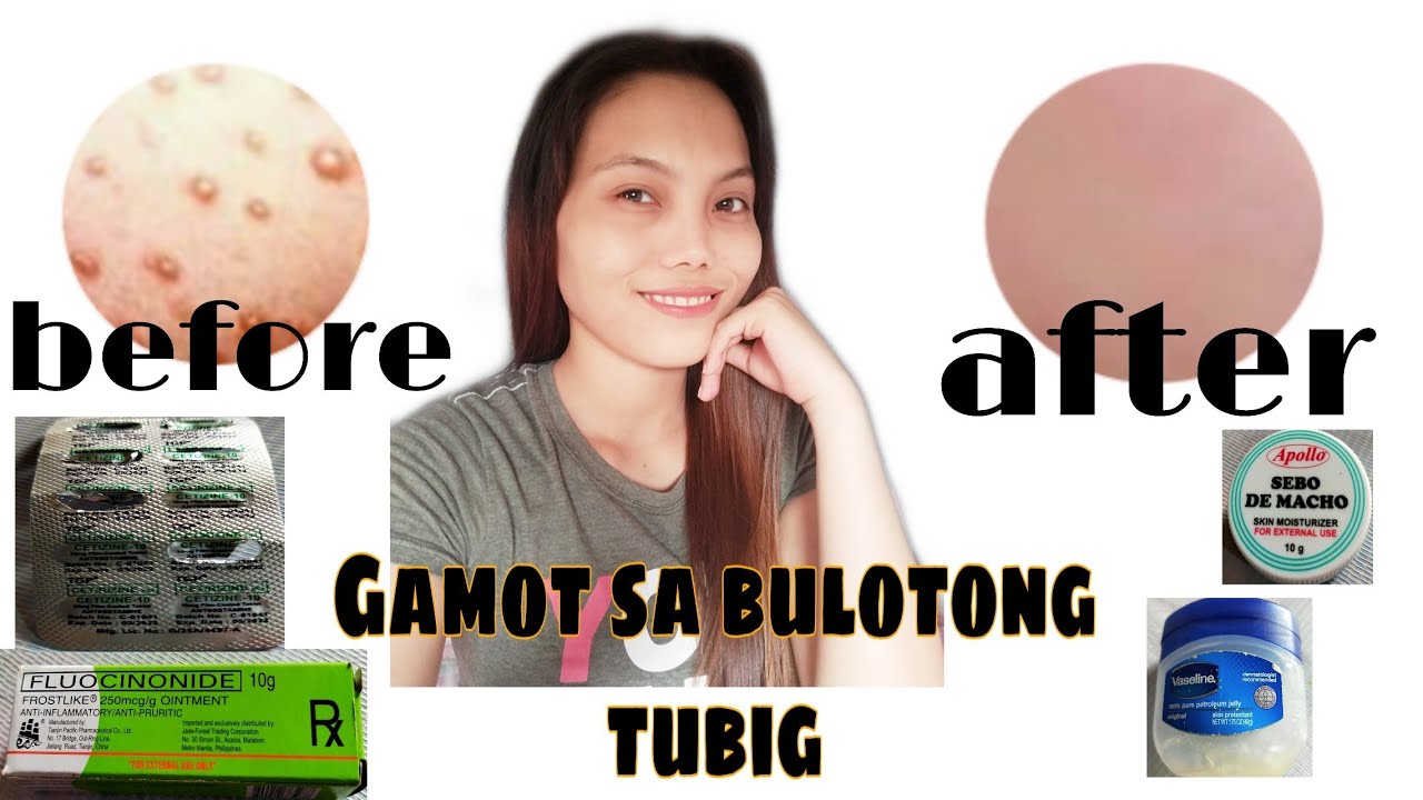 Anong Gamot sa bulutong tubig o chicken fox