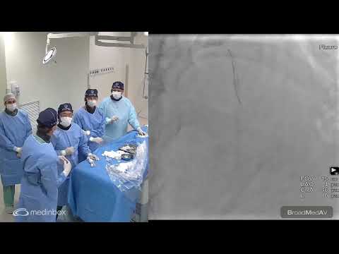 PCI Of LAD ISR Guided By IVUS