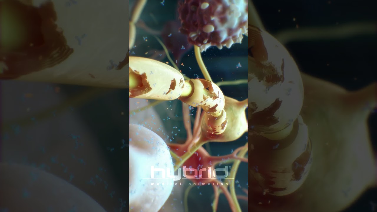 Multiple sclerosis (MS) animation | myelin sheath destruction | medical animation | MS animation