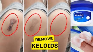 3 Effective remedies to remove keloid scars naturally | Home Remedies for Keloids