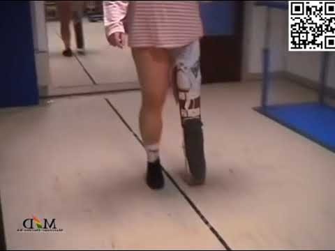 Sexy woman with very short leg and calliper.