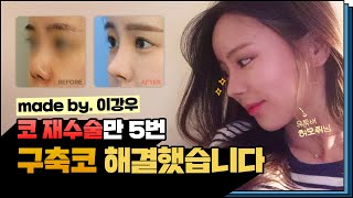 허모뤼님 구축코 수술에서 어려웠던 점은요...  (ft. 마인드성형외과 - 이강우 원장님)