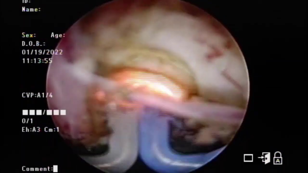 Prostate Vaporization