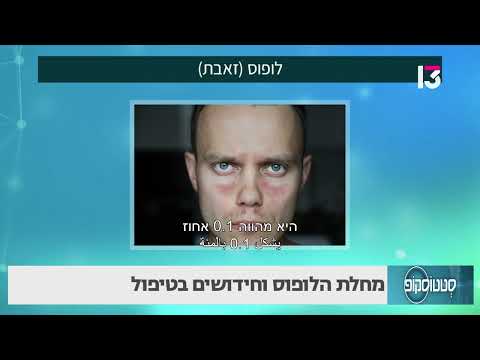 מחלת הלופוס וחידושים בטיפול