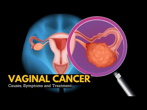 Vaginal cancer, Causes, Signs and Symptoms, DIagnosis and Treatment.