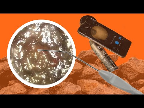 We tackle a ROCK HARD ear wax plug. #001