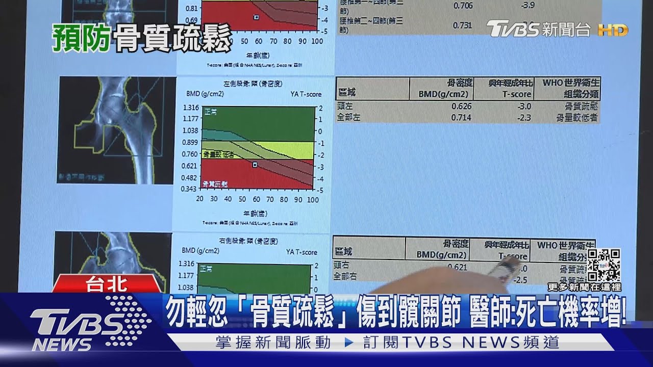 不重視「骨質疏鬆」!若不小心發生「這件事」 醫師:死亡機率增!