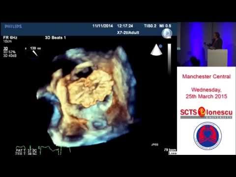 Transcatheter Mitral Valve Implantation: Challenges and Opportunities