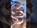 Immediately after facial Tumors were removed and reconstruction done for Ravi kumar