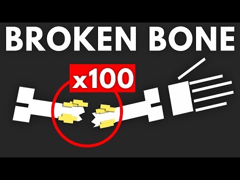 你能夠在同樣的地方骨折多少次？（How Many Times Can You Break The Same Bone?）