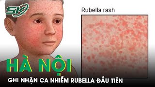 Ghi Nhận Ca Mắc Rubella Đầu Tiên Tại Hà Nội Trong Năm 2024  | SKĐS