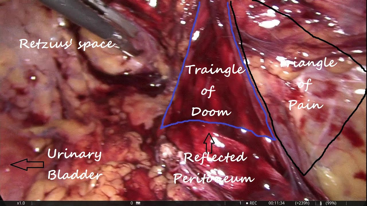 TEP Indirect Hernia