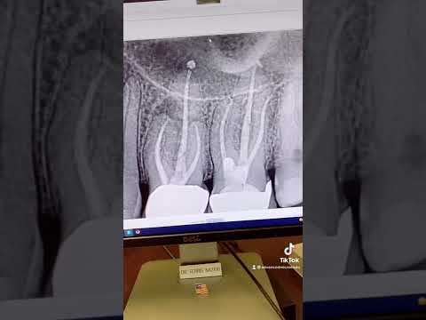 Endodontist had missed an MB2! Endodontic retx of tooth #14.