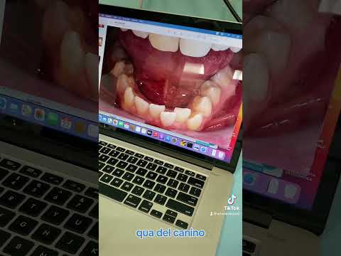 PRIMA E DOPO! - MASCHERINE TRASPARENTI