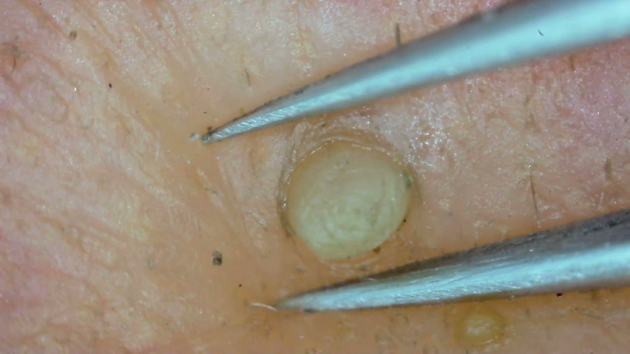 0331 keratin plug removal nose