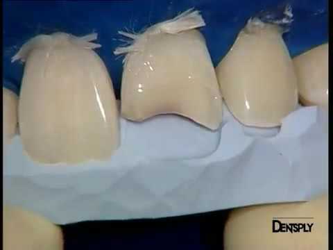 Реставрация фронтальных групп зубов