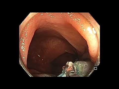 Colonoscopia: resección endoscópica de la mucosa por etapas de colon transverso