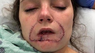 Woman Gets Surgery to Restore Lip Her Ex-Boyfriend Bit Off